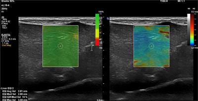 Shear wave elastography measurements in dogs treated surgically for congenital extrahepatic portosystemic shunts